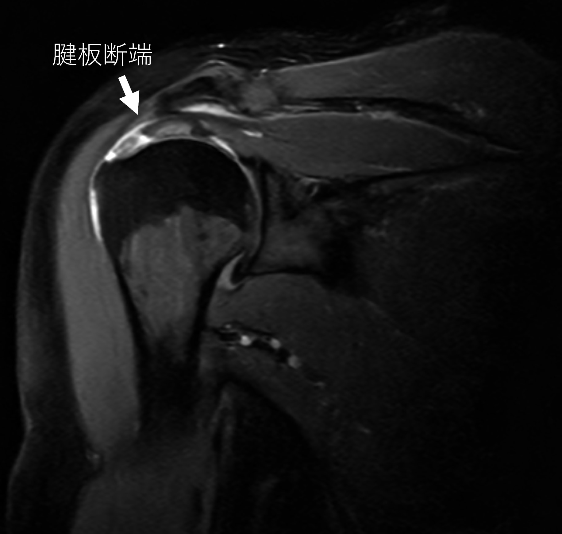 【肩腱板断裂】MRI_腱板断裂