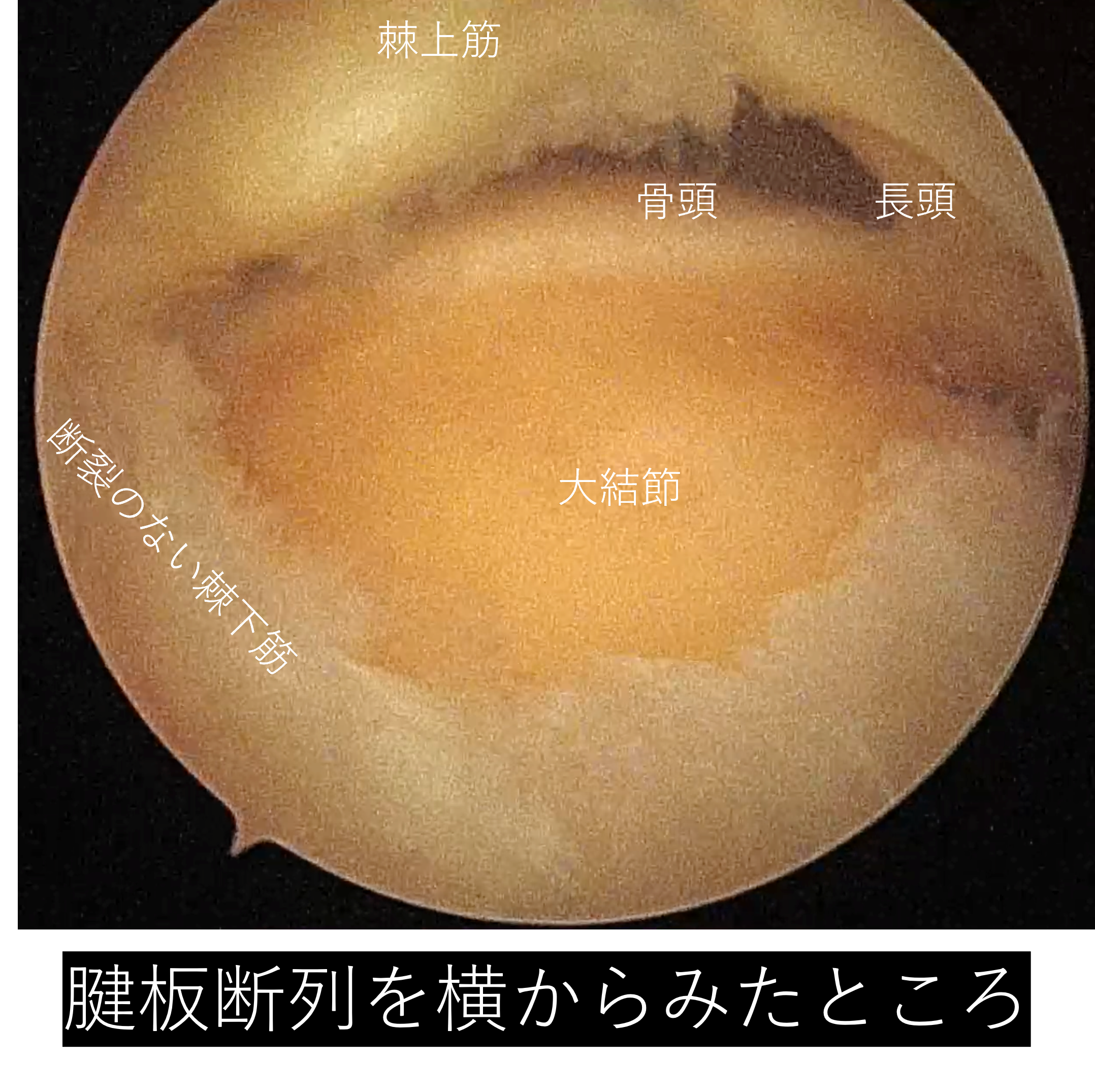【肩腱板断裂】手術_腱板断裂_02