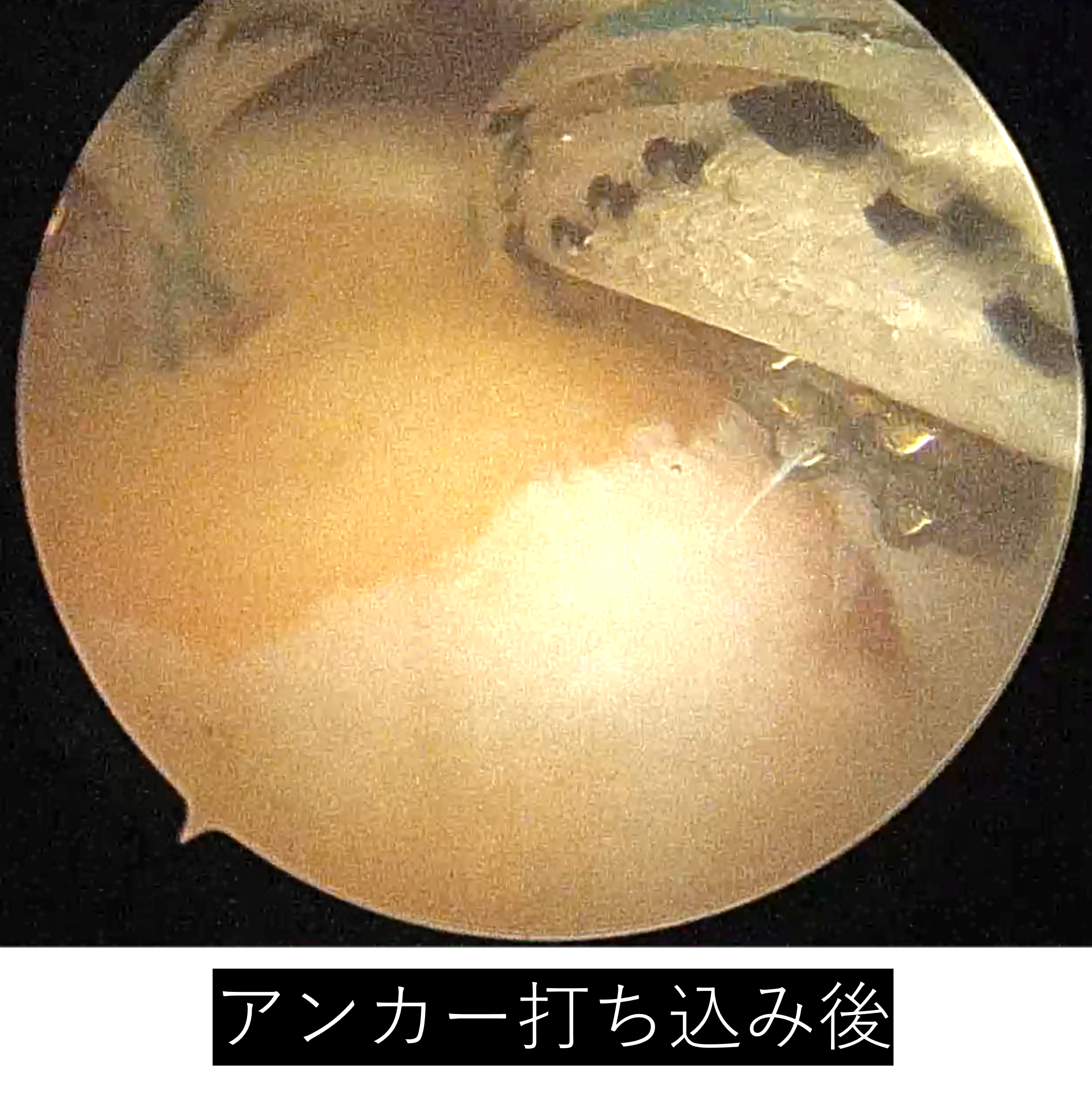 【肩腱板断裂】手術_腱板断裂_03