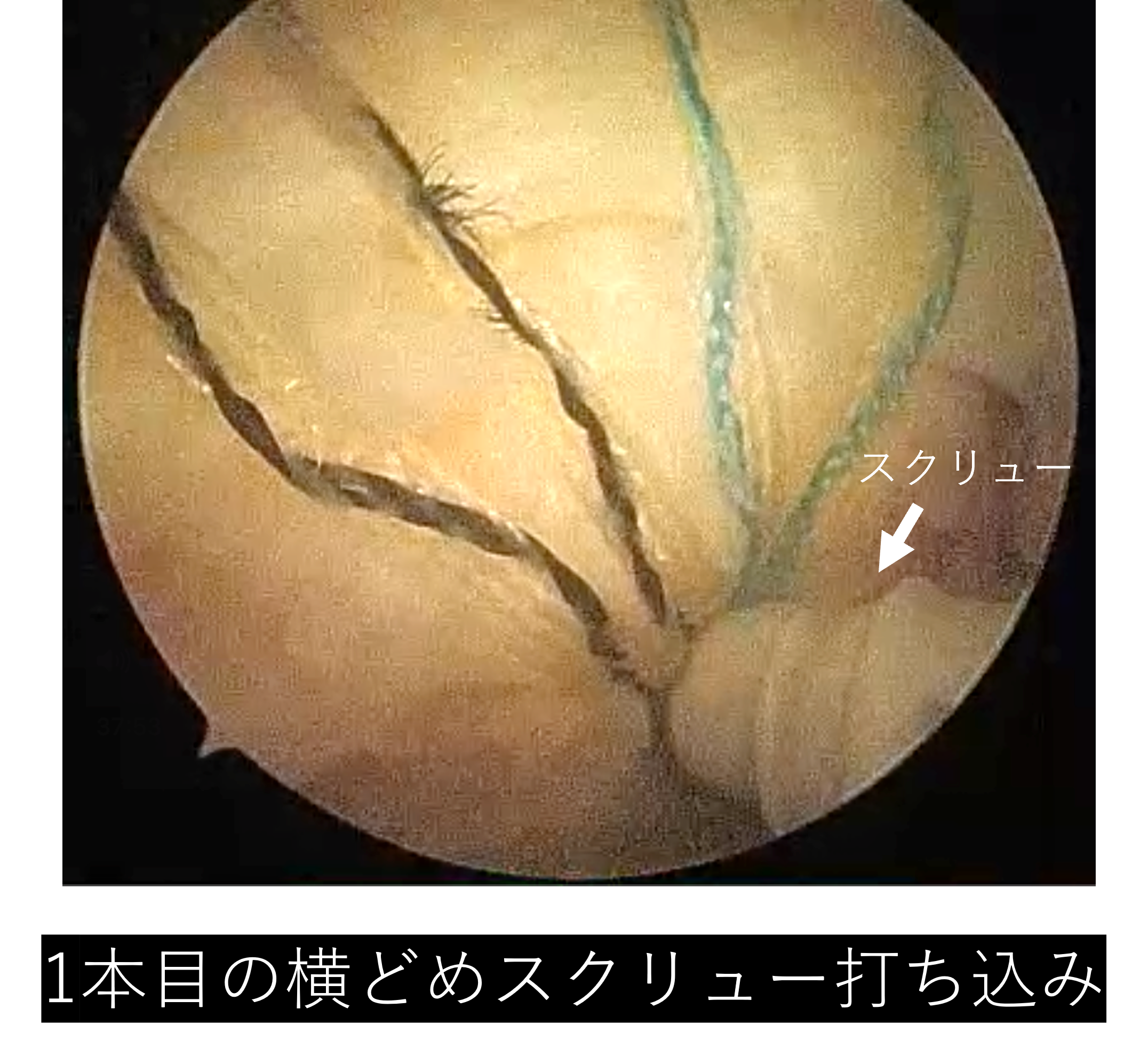 【肩腱板断裂】手術_腱板断裂_04