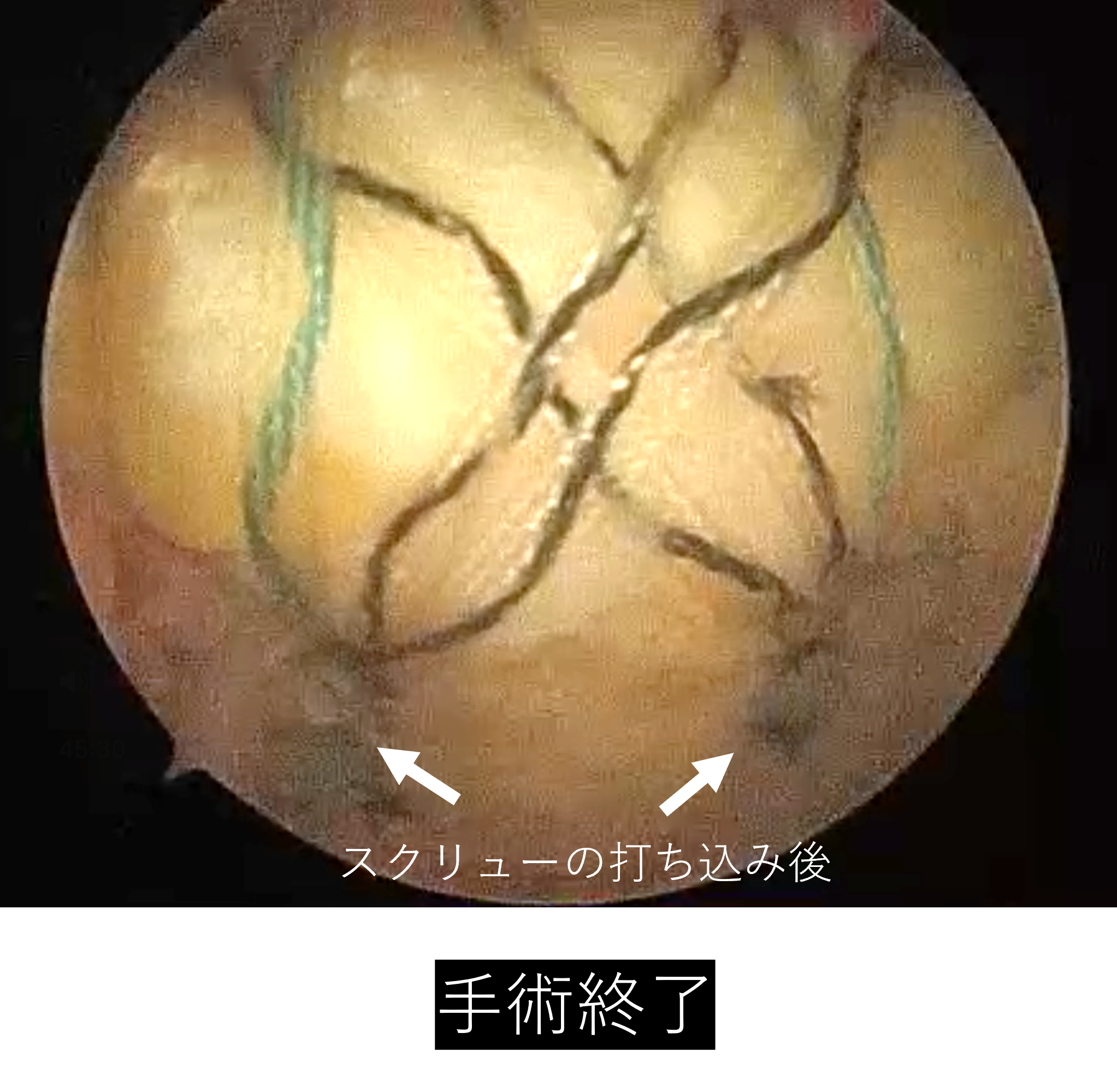 【肩腱板断裂】手術_腱板断裂_05