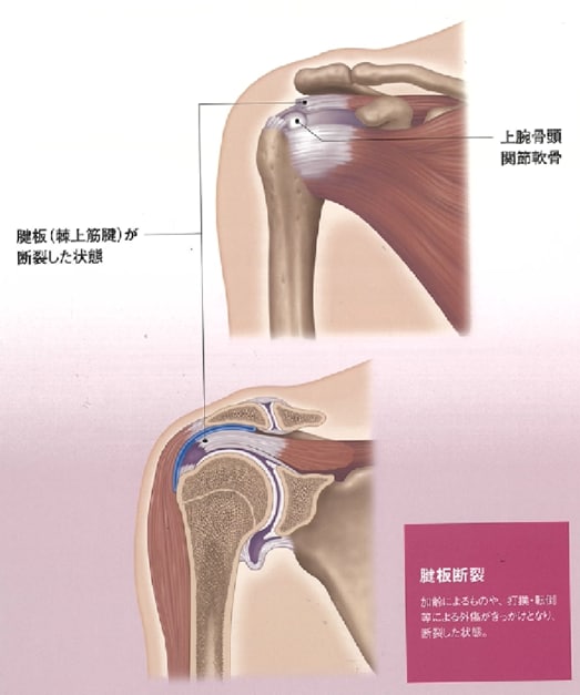 【肩腱板断裂】右肩_02