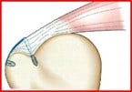 【肩腱板断裂】手術_腱板断裂_01